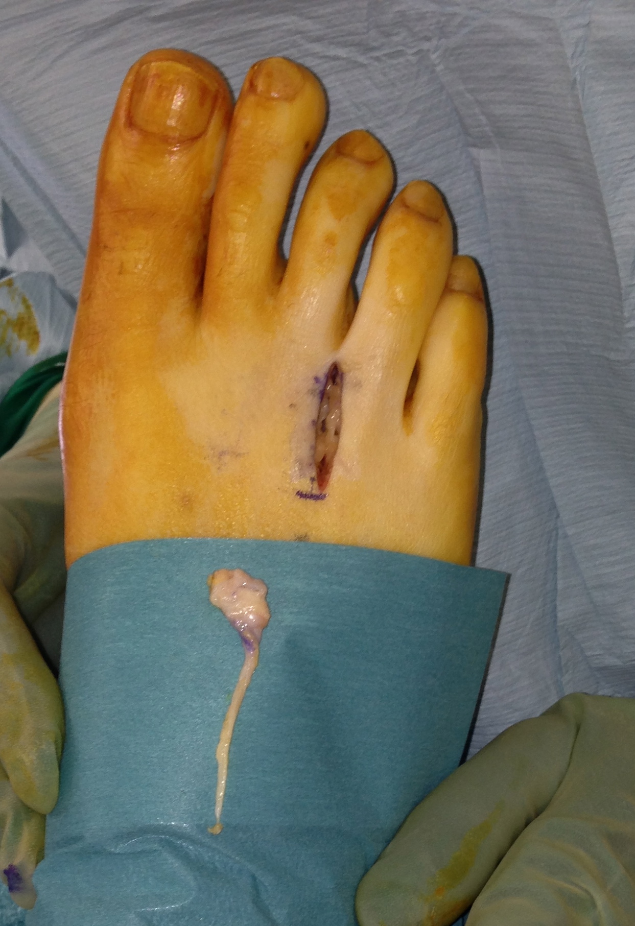 Foot and Ankle Surgeon Sam Singh Morton's Neuroma A